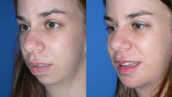 chin augmentation