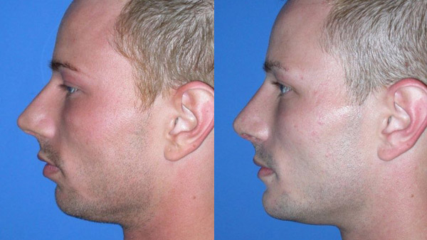 chin augmentation