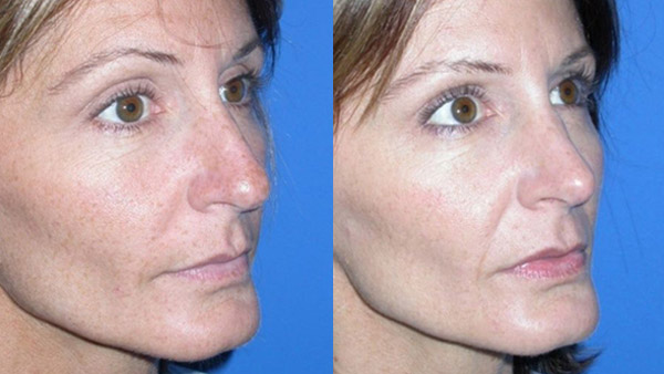 Rhinoplasty