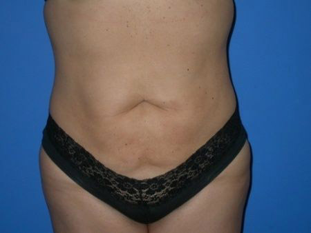 after Liposuction Abdomen