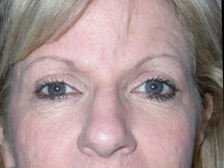 brow lift