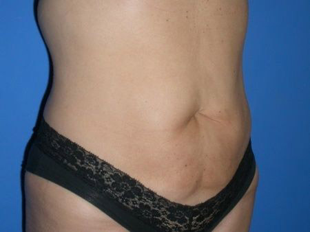 after Liposuction Abdomen