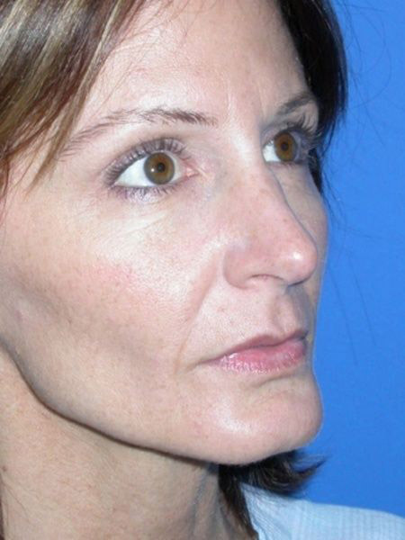 Rhinoplasty