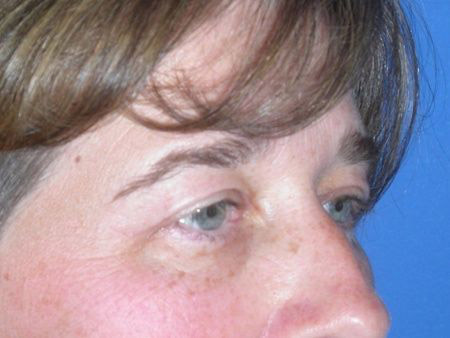 blepharoplasty