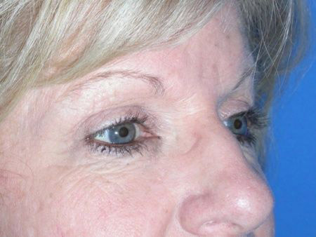 brow lift