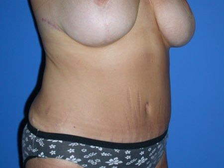 after abdominoplasty