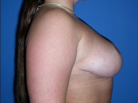 breast reduction