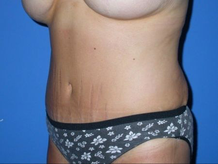 after abdominoplasty