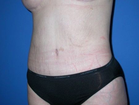 after belt lipectomy