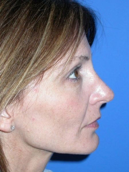 Rhinoplasty