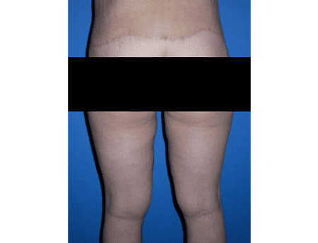 after thighplasty