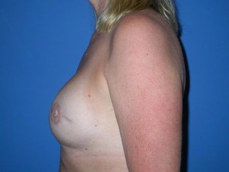 breast reconstruction