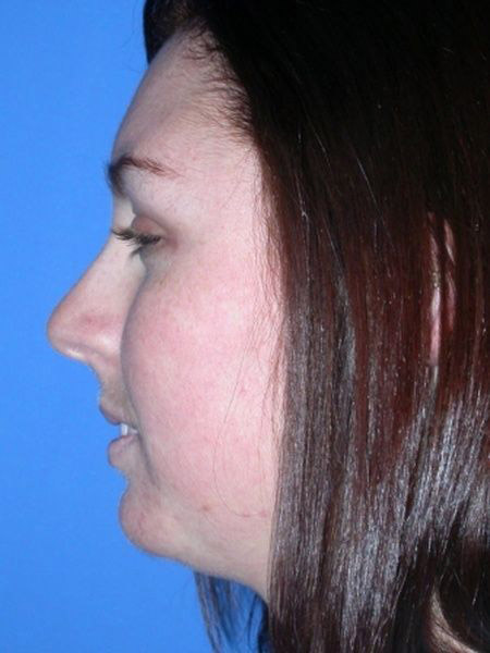 chin augmentation