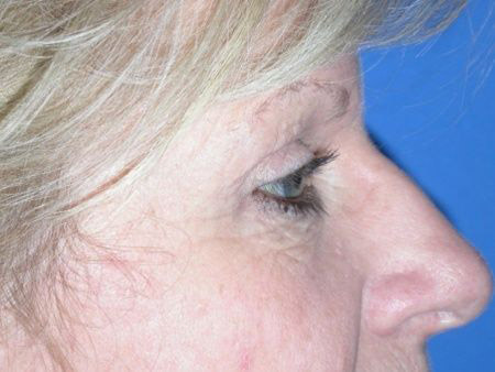 brow lift