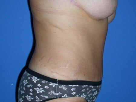 after abdominoplasty