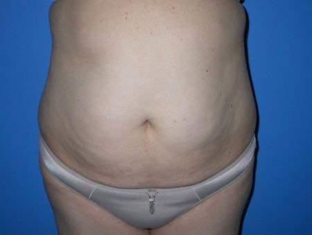 before Liposuction Abdomen