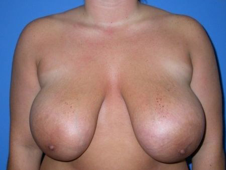 breast reduction