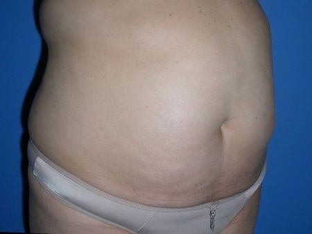 before Liposuction Abdomen