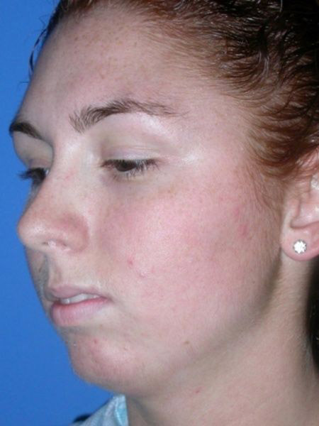 chin augmentation