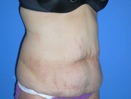 before abdominoplasty