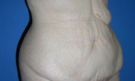 before belt lipectomy