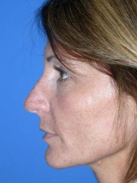 Rhinoplasty