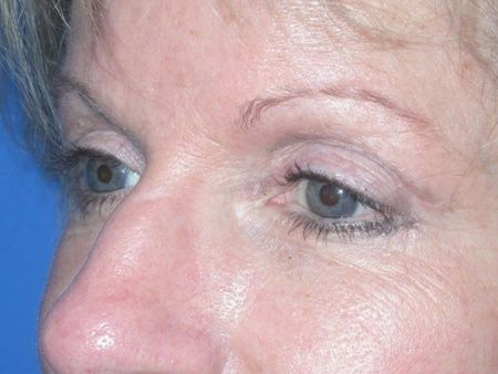 brow lift