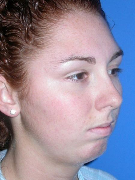 chin augmentation