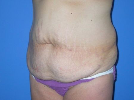 before abdominoplasty