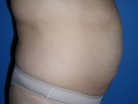 before Liposuction Abdomen