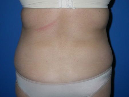 before Liposuction Abdomen