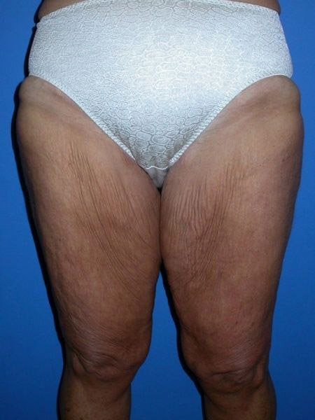 after thighplasty