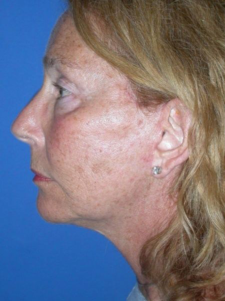blepharoplasty
