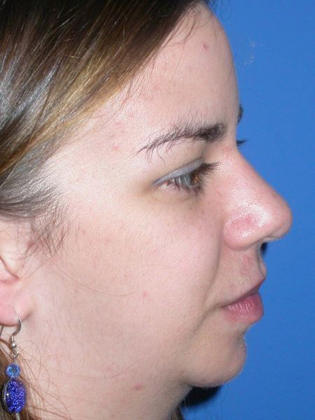 chin augmentation