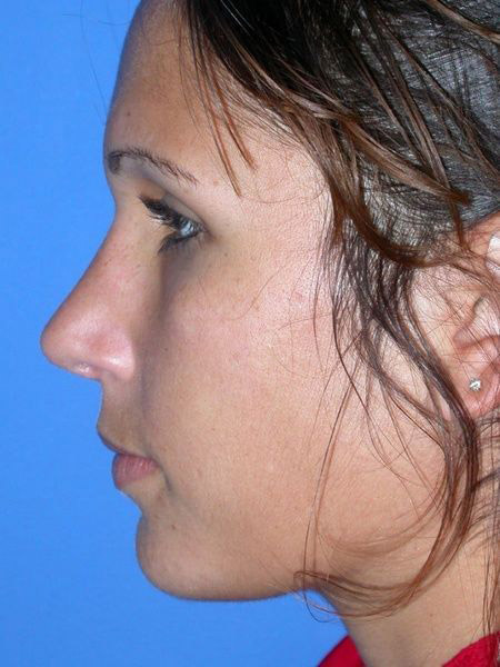 Rhinoplasty