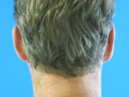 otoplasty