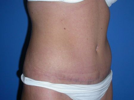 after abdominoplasty