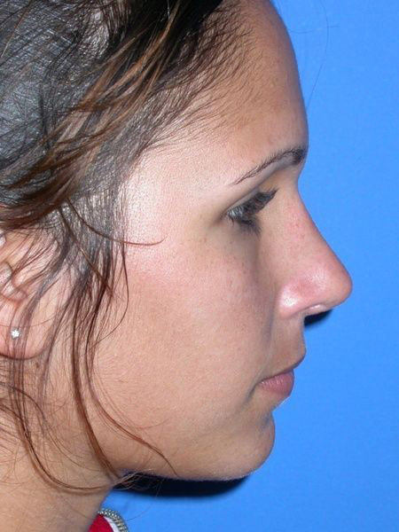 Rhinoplasty