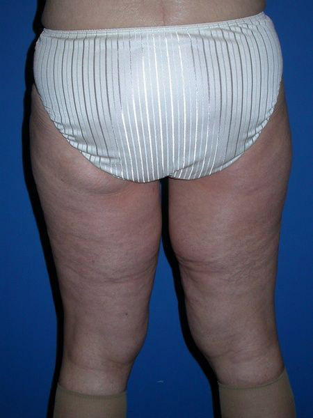 after thighplasty