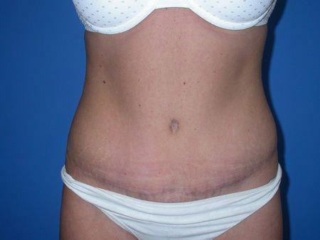 after abdominoplasty