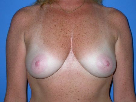 breast augmentation