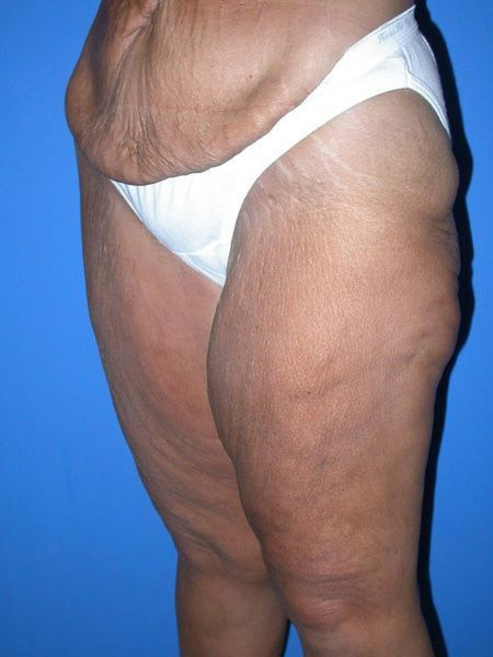 thighplasty