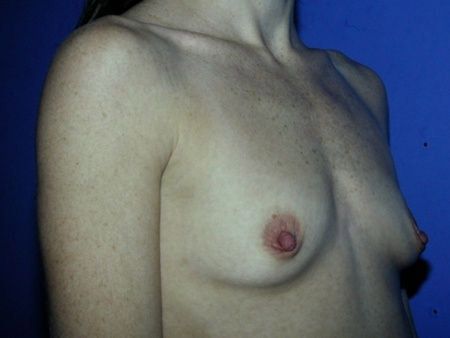 breast reconstruction