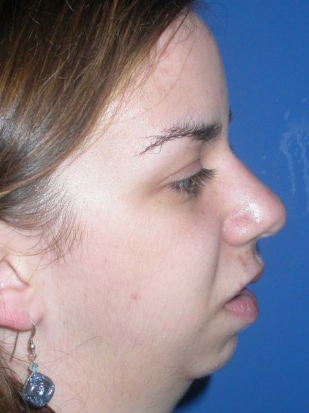 chin augmentation