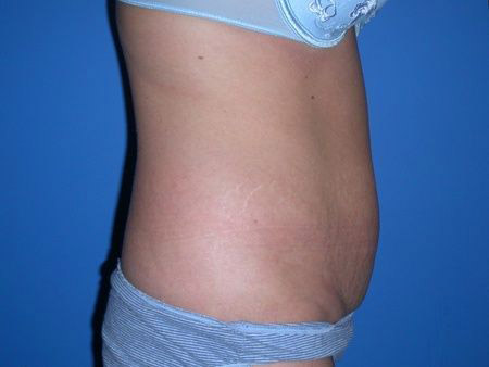 before abdominoplasty