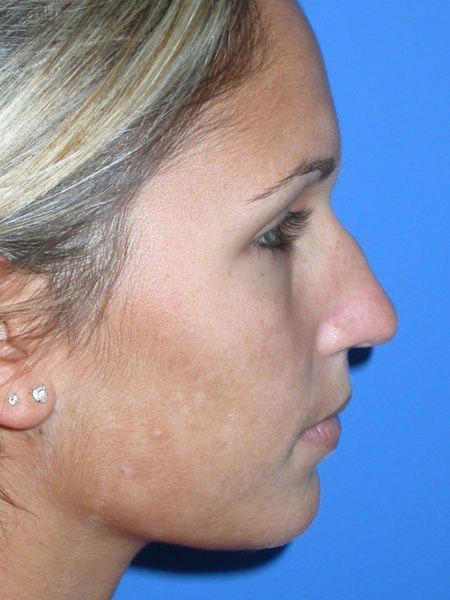 Rhinoplasty