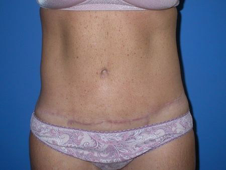 after belt lipectomy