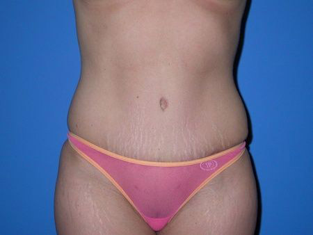 after abdominoplasty