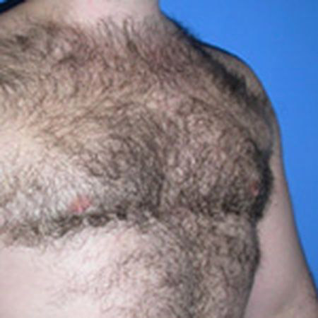 after Liposuction Abdomen