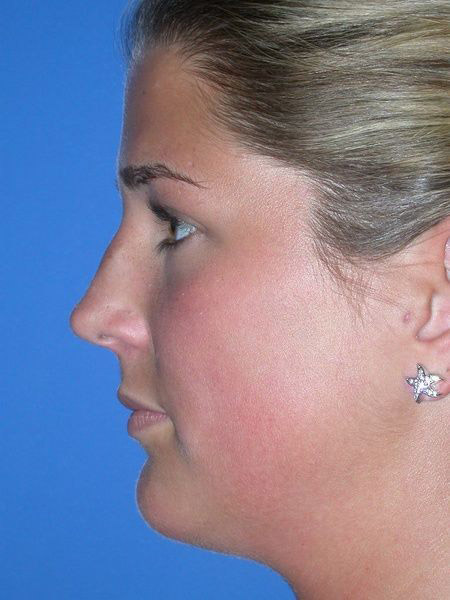 Rhinoplasty